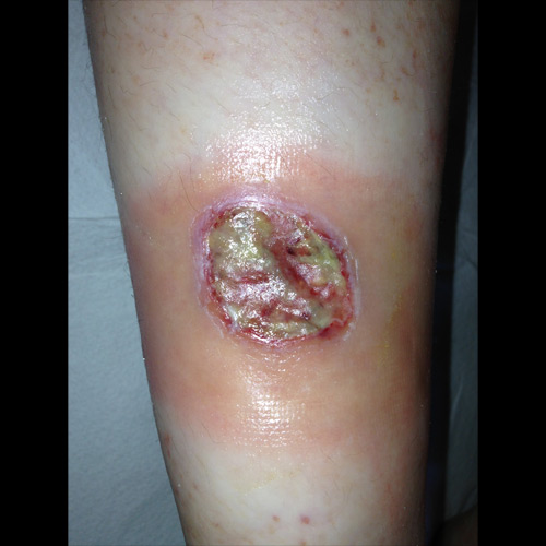 Pioderma gangrenoso-like in LAD-I